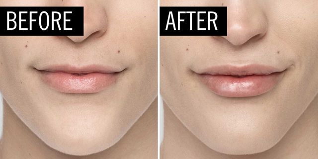 top lip injections near me