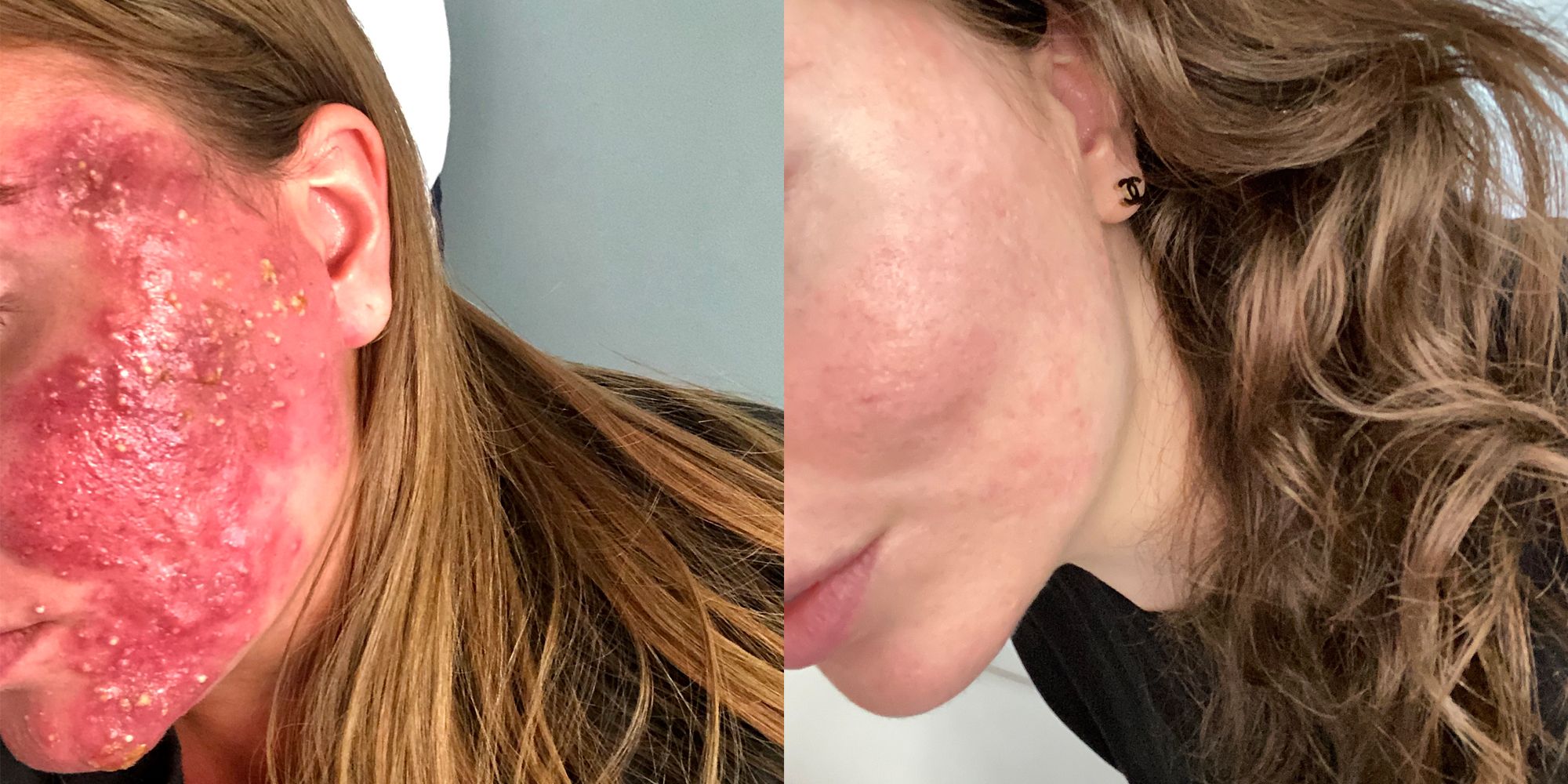 Roaccutane: What It's Like to Take the Acne-control Medication