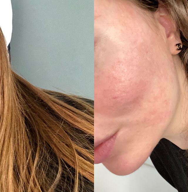 Roaccutane: What It's Like to the Acne-control