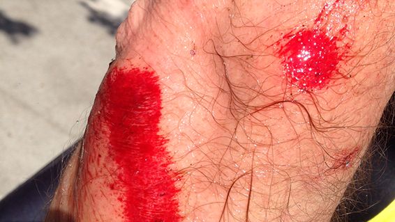2nd degree road rash 2nd degree road rash
