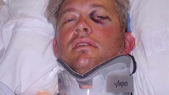 motorcycle road rash pictures