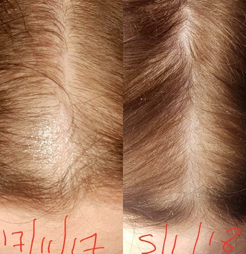 How Rogaine Regrew This Woman's Thinning Hair in 6 Weeks - Rogaine