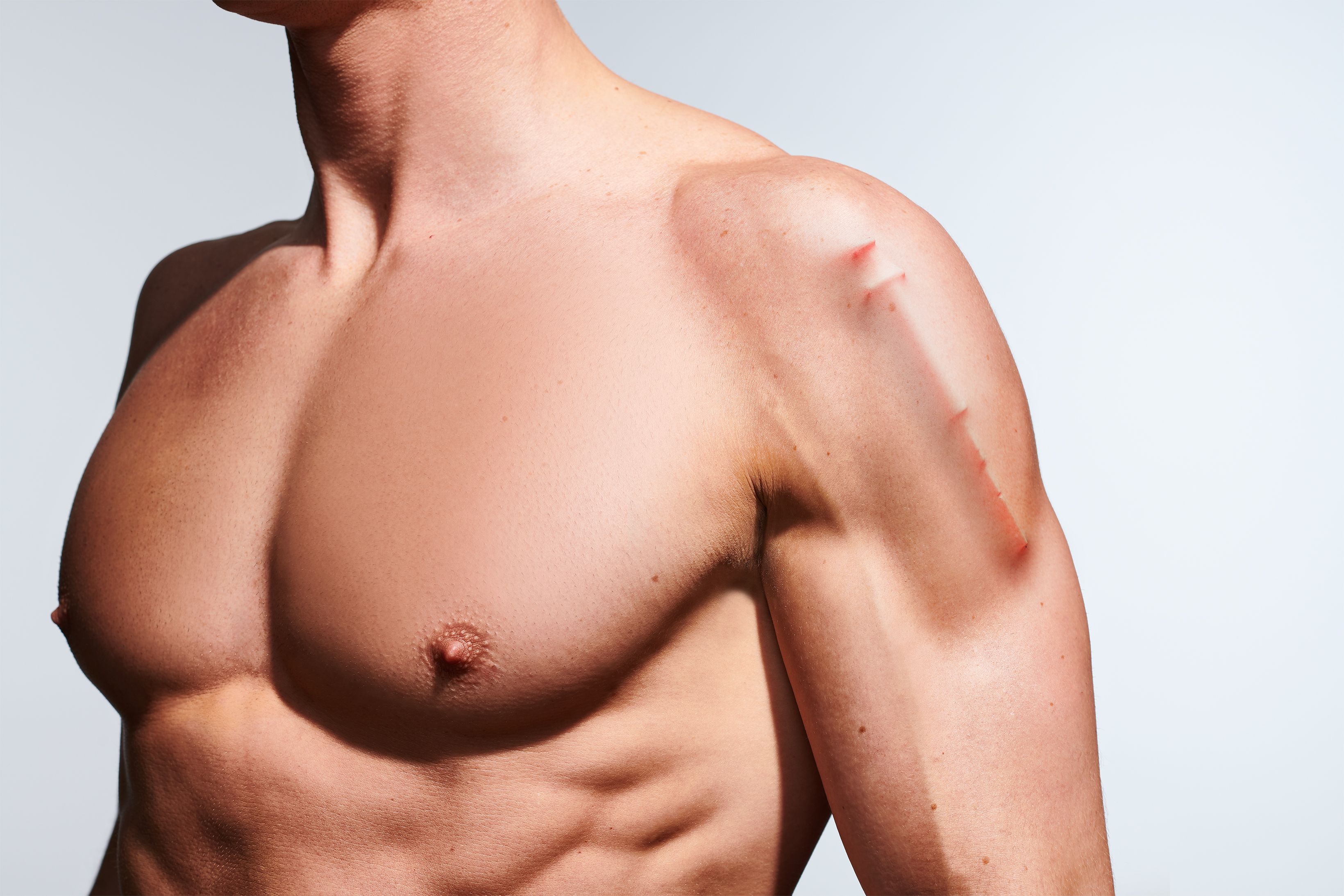 10 Reasons You Need To Stop Stressing About gyno steroids