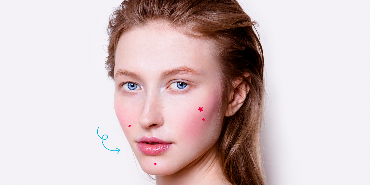 Papulopustular Rosacea: How to Treat Your Acne Rosacea Breakouts