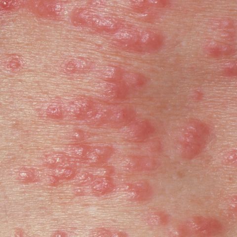 5 Types Of Bug Bites Causes Of Bug Bite Rashes