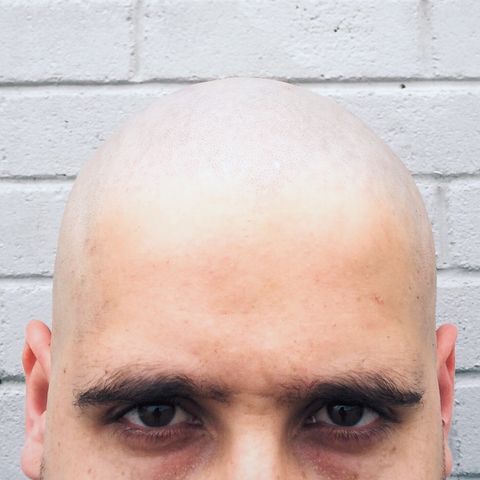 beat baldness