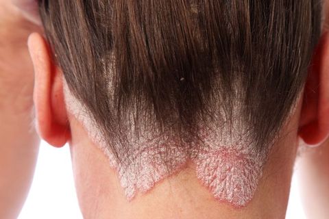 psoriasis treatment scalp best