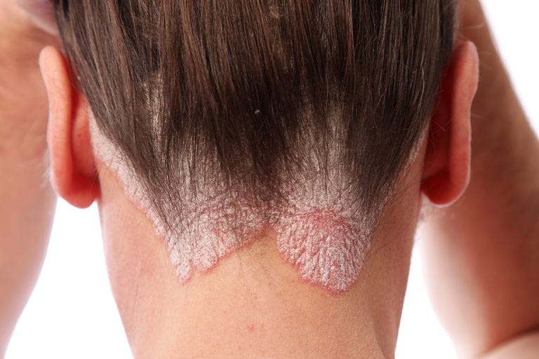 psoriasis in hindi