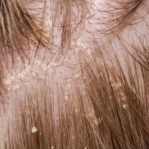dandruff in the hair of a person