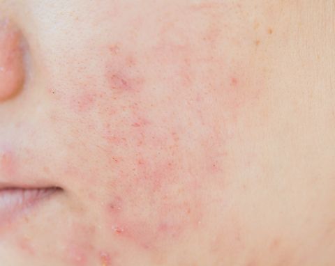 scar  from acne  on face