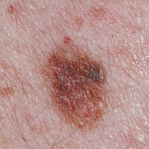Is It Just A Mole—Or Something Worse? | Prevention