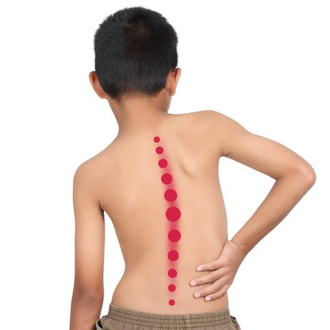 Image result for What Are The Causes of Scoliosis?