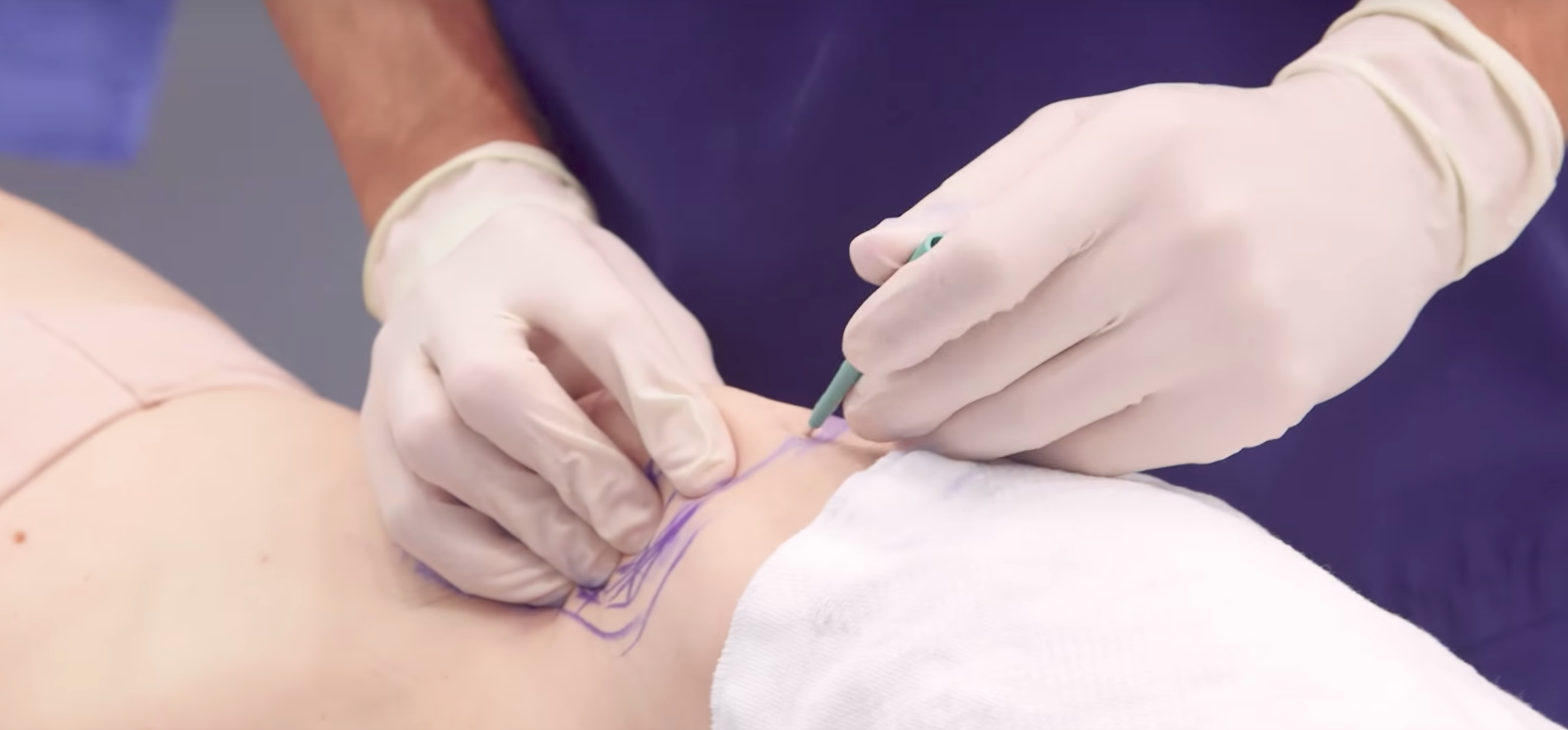 This New Liposuction Technique Will Blow Your Mind