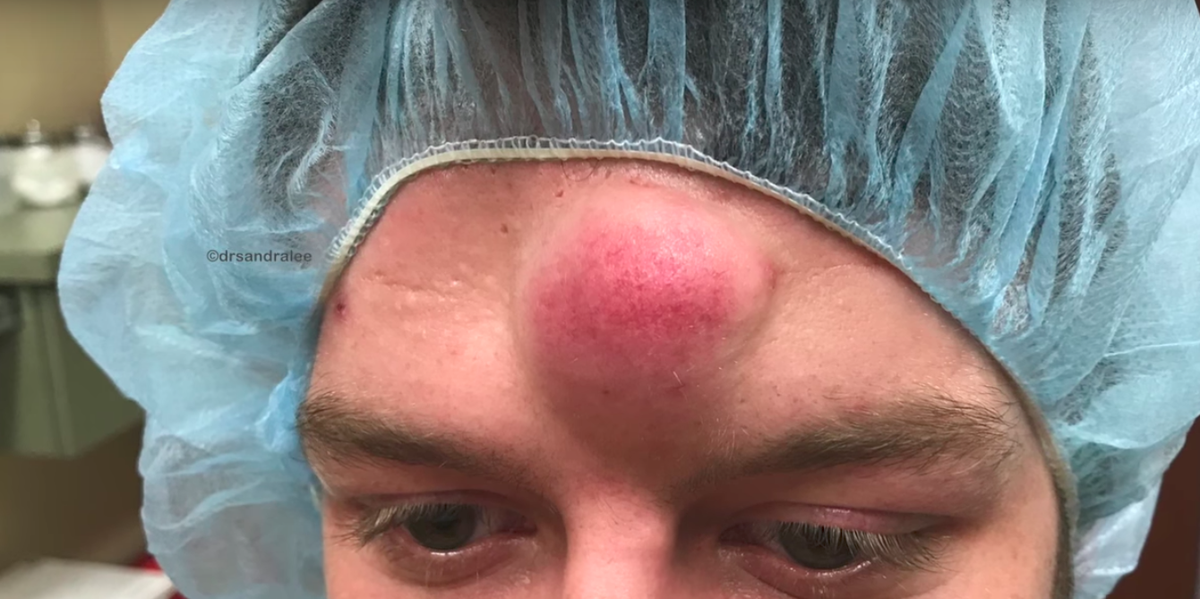 Watch Dr Pimple Popper Go To Town On This Fully Ripe 6 Year Old