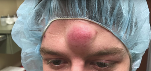 Watch Dr. Pimple Popper Remove a HUGE Cyst From a Woman's Temple