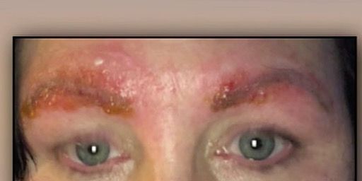 A Discount Microblading Session Gave This Woman a Horrifying Infection—In Her Eyebrows