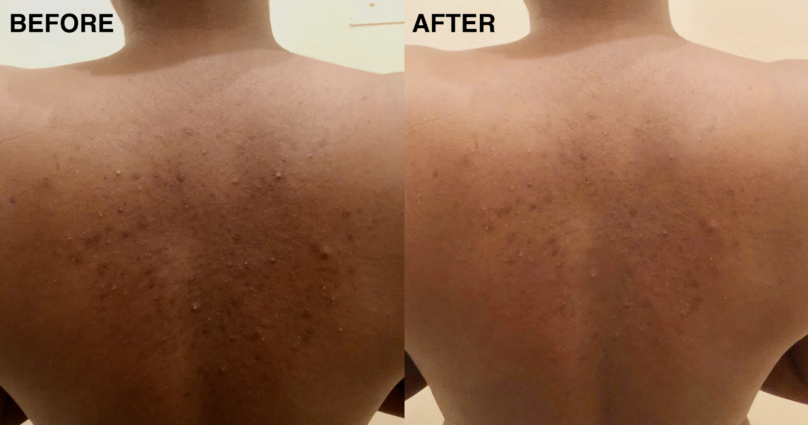 back acne scars treatment