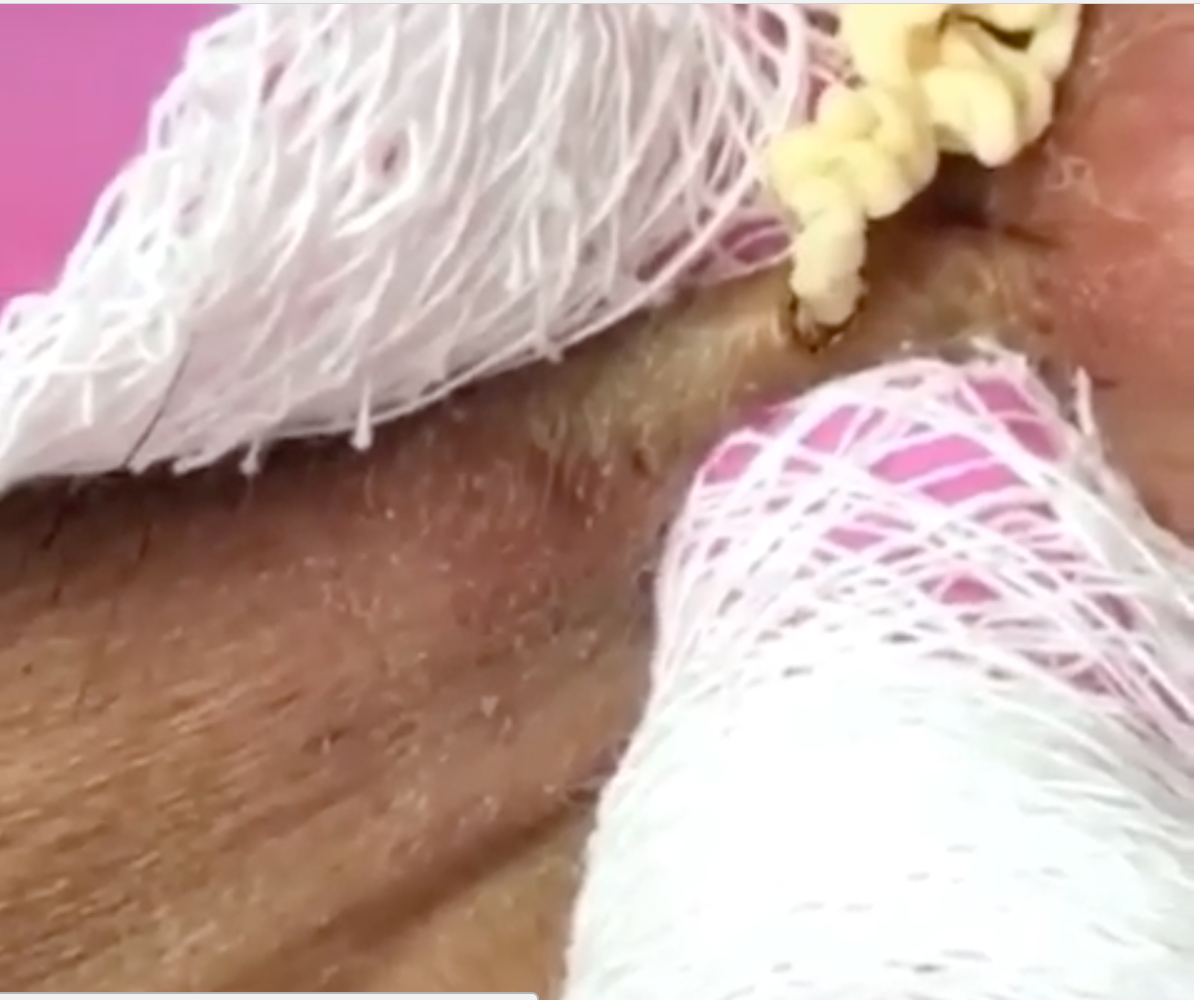 Pimple Popping Video Shows Clogged Pore Unleashing Vile Stream Of Pus