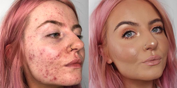 This Foundation Is Going Viral After Cystic Acne Sufferer Shares Her Amazing Before And After Pics