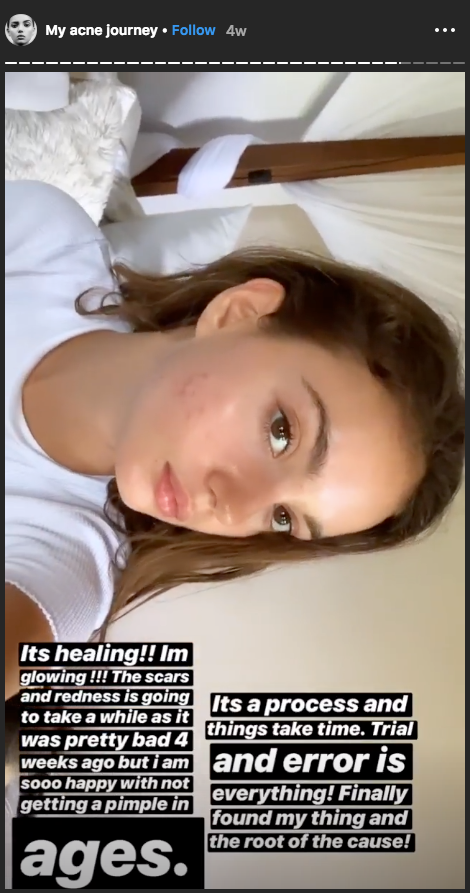 Inka Williams acne