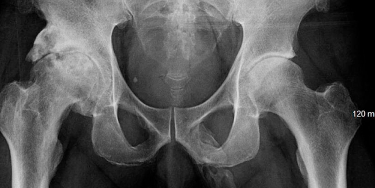 Medicii au incremenit cand i-au vazut radiografia. Cazul lui a ajuns in revistele de specialitate