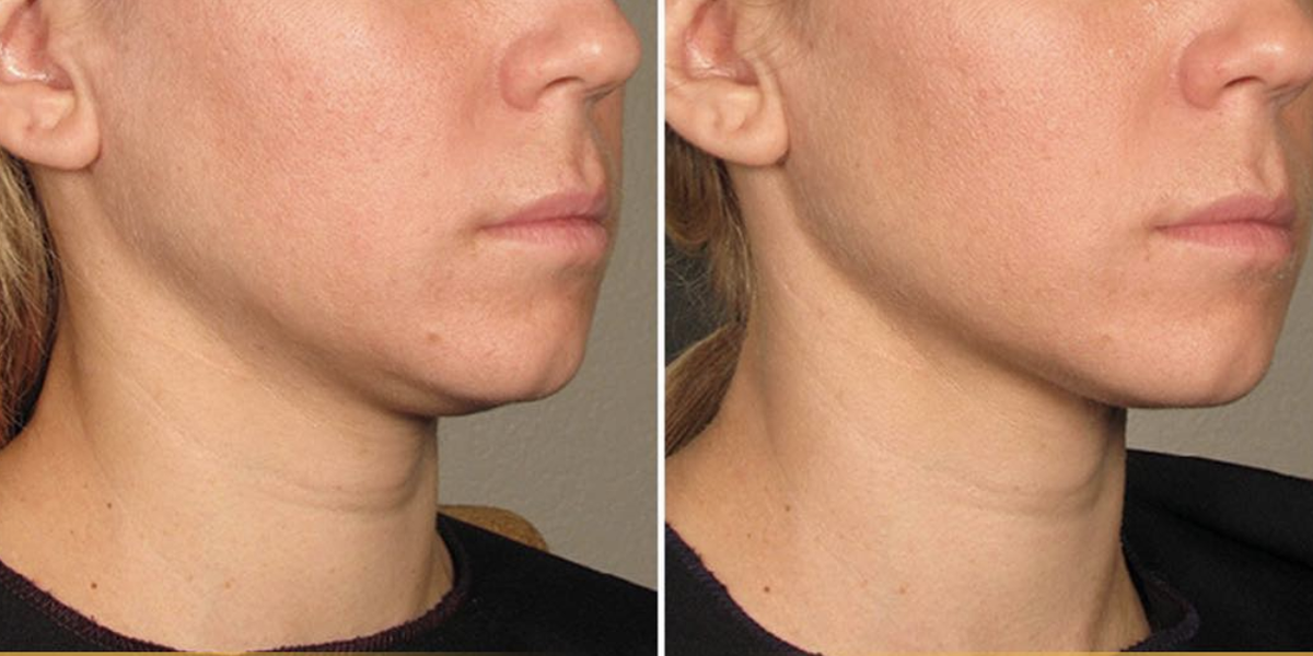 What Is Ultherapy and How Much Does It Cost? - Skin Tightening