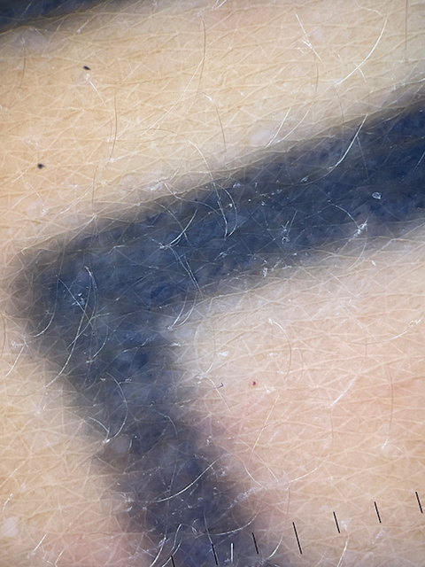 tattoo removal