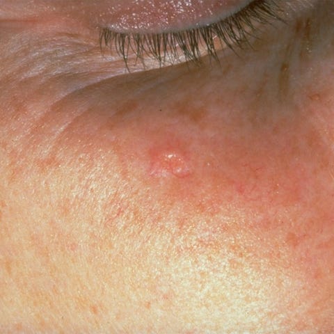 Sebaceous Hyperplasia Face