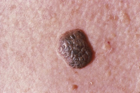 seborrheic keratosis