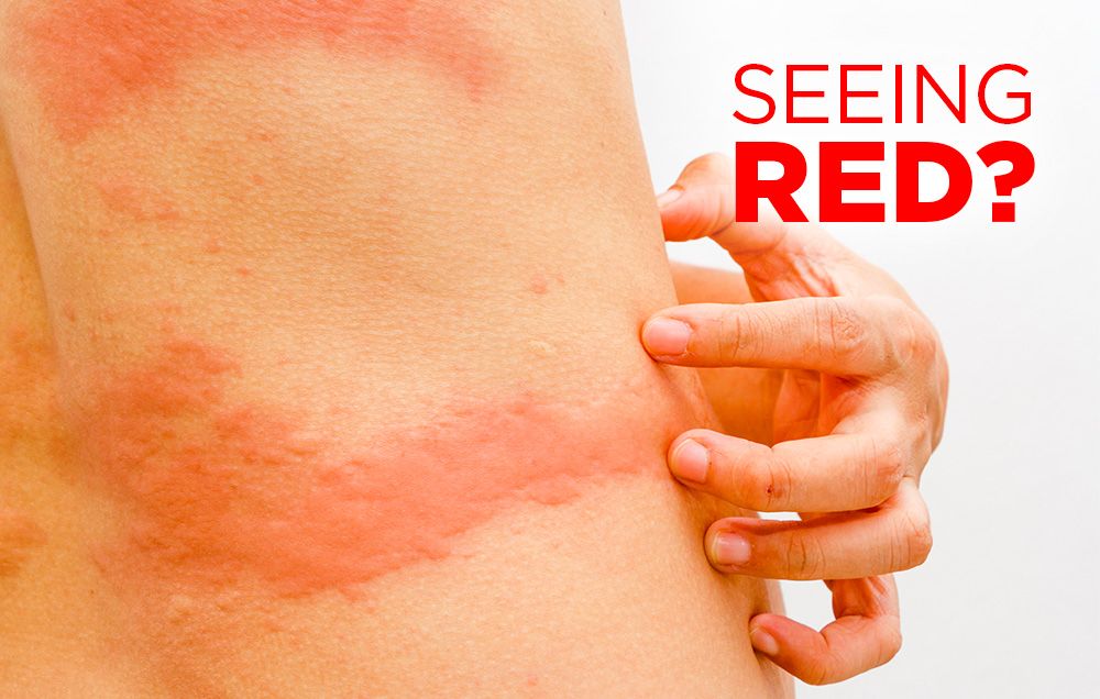 Itchy Rash On Body Hives Information Mount Sinai New York Itchy