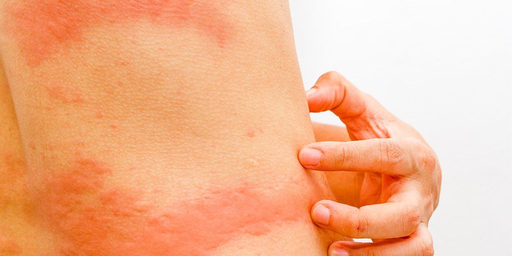 Whats That Rash On Your Body 5 Common Types Explained Prevention