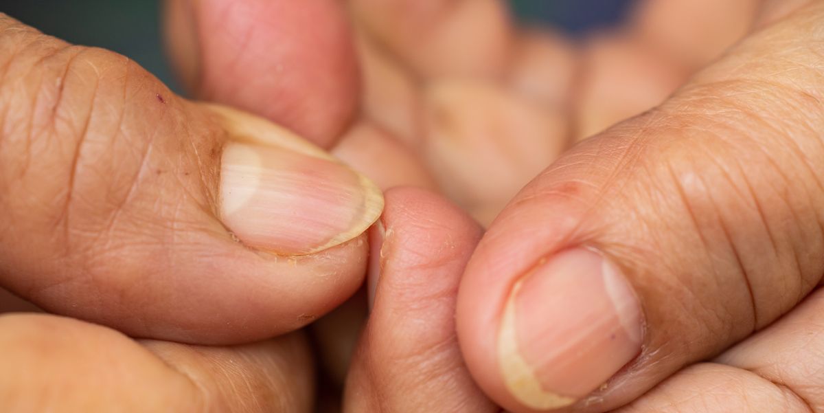 8 Reasons Your Nails Are Yellow According To Dermatologists
