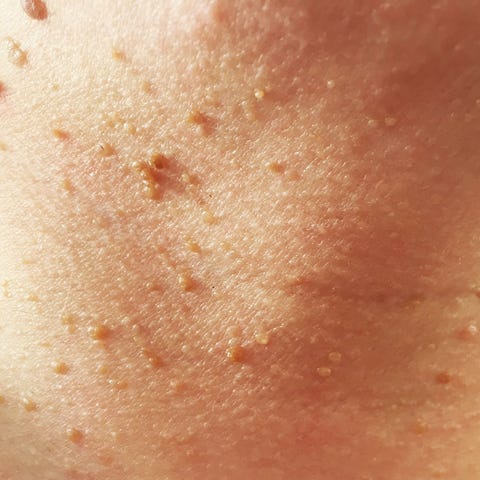 13 Face Bumps You Get Under Your Skin And How To Get Rid Of Them