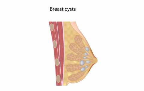 breast cysts