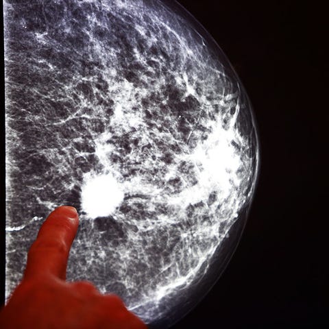 mammogram mammogram