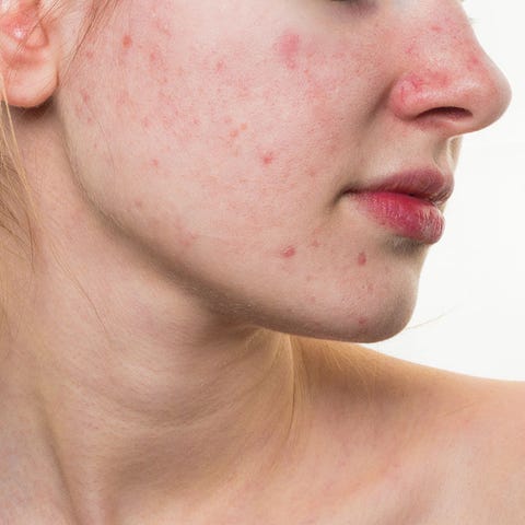 Acne breakout Acne breakout
