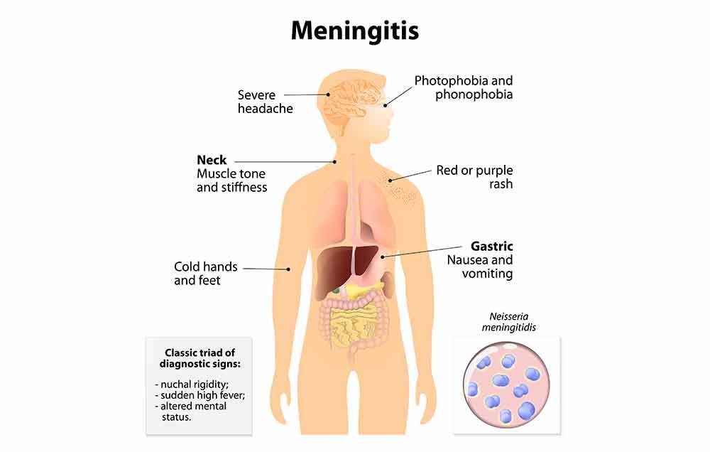 5 Signs Of Meningitis You Should Know Prevention