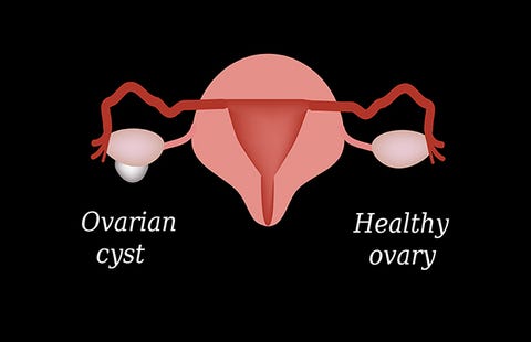 5 Things You Need To Know About Having Your Ovaries Removed | Prevention