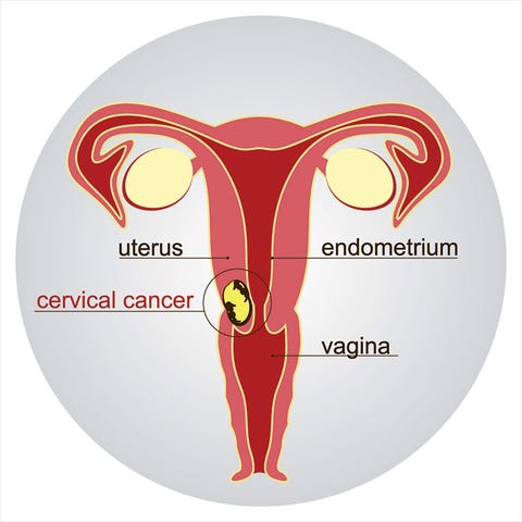 cervical cancer cervical cancer