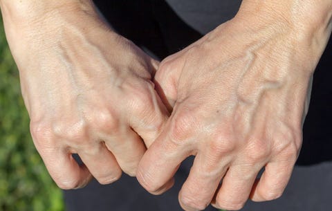 Bulging veins Bulging veins