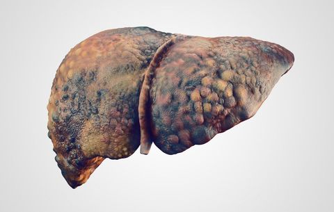 Diseased liver