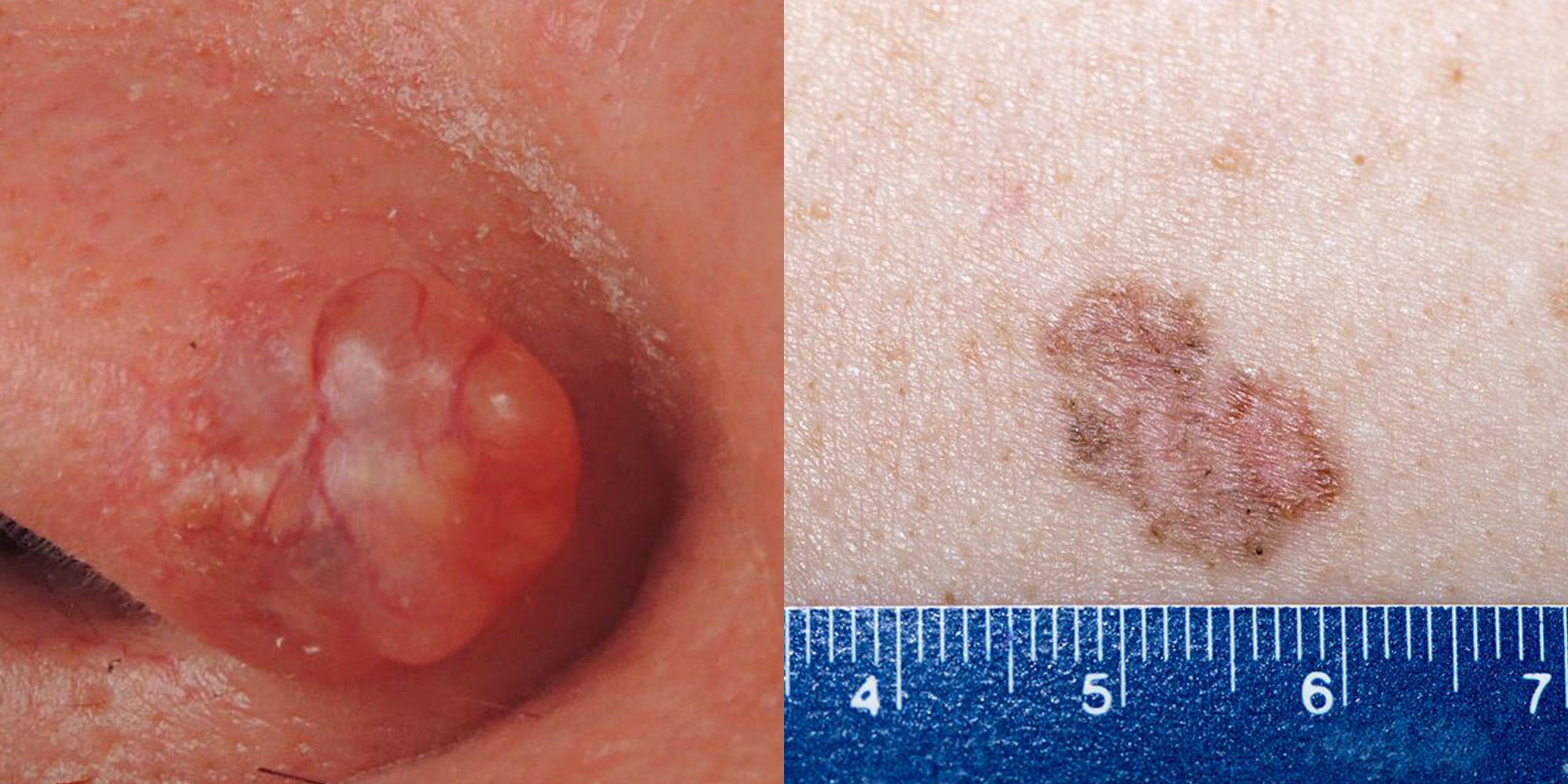 warts on skin or skin cancer