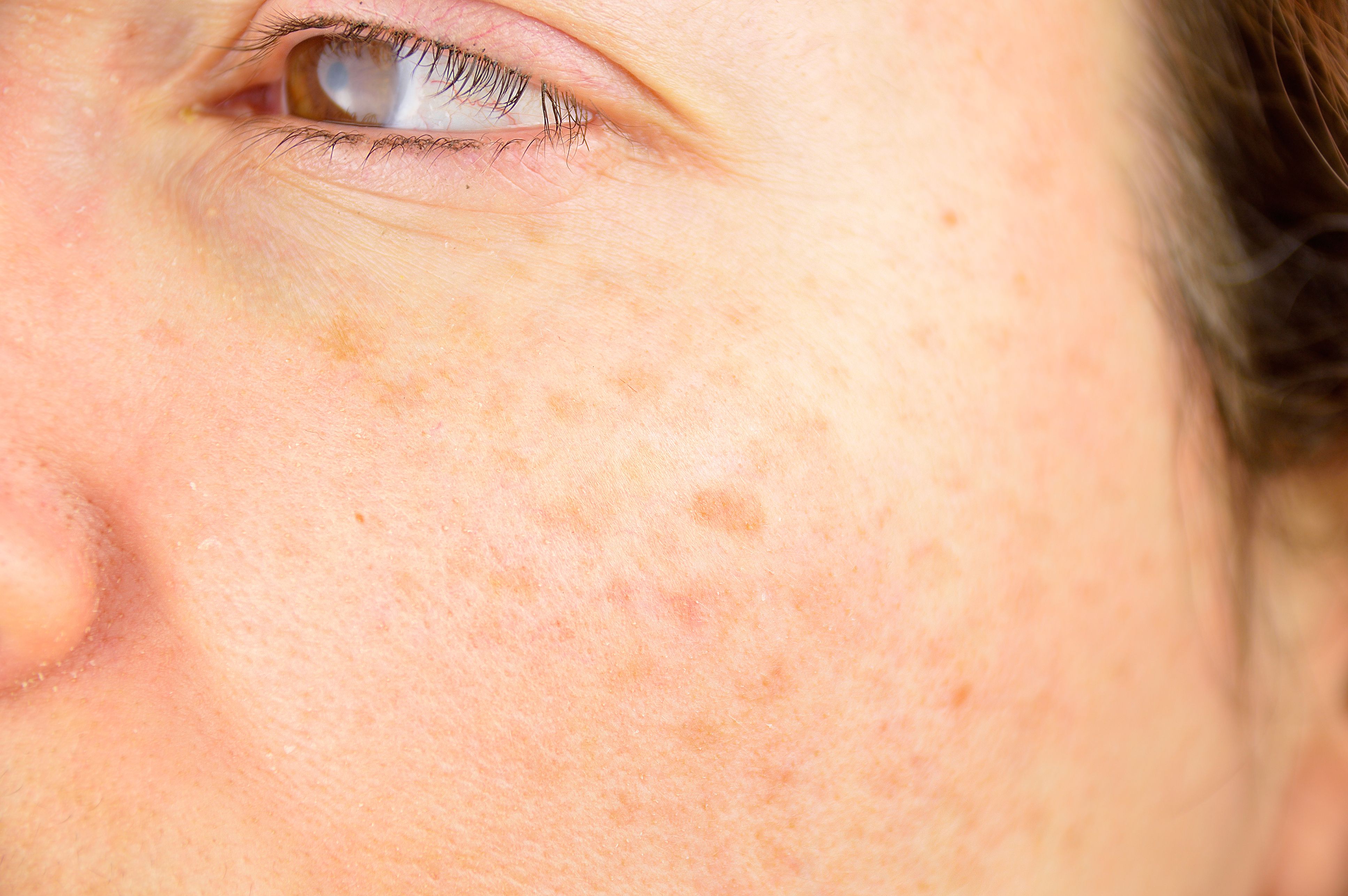 does peroxide lighten dark spots face