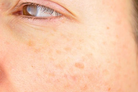 7 Best Ways To Get Rid Of Age Spots Top Removers For Dark Spots 7 Best Ways To Get Rid Of Age Spots Top Removers For Dark Spots