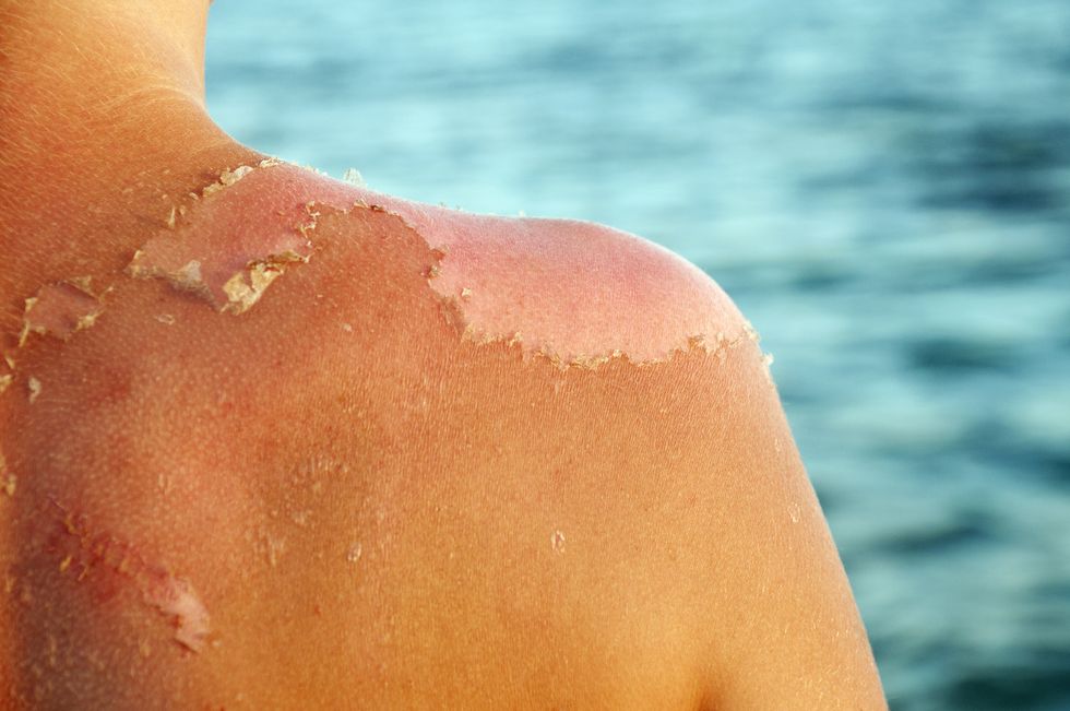 Peeling kůže v důsledku spálení sluncem