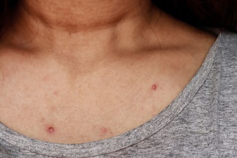 Skin problem,  acne, red spots. Asian women scratching her shoulder with pimples.skin diseases.