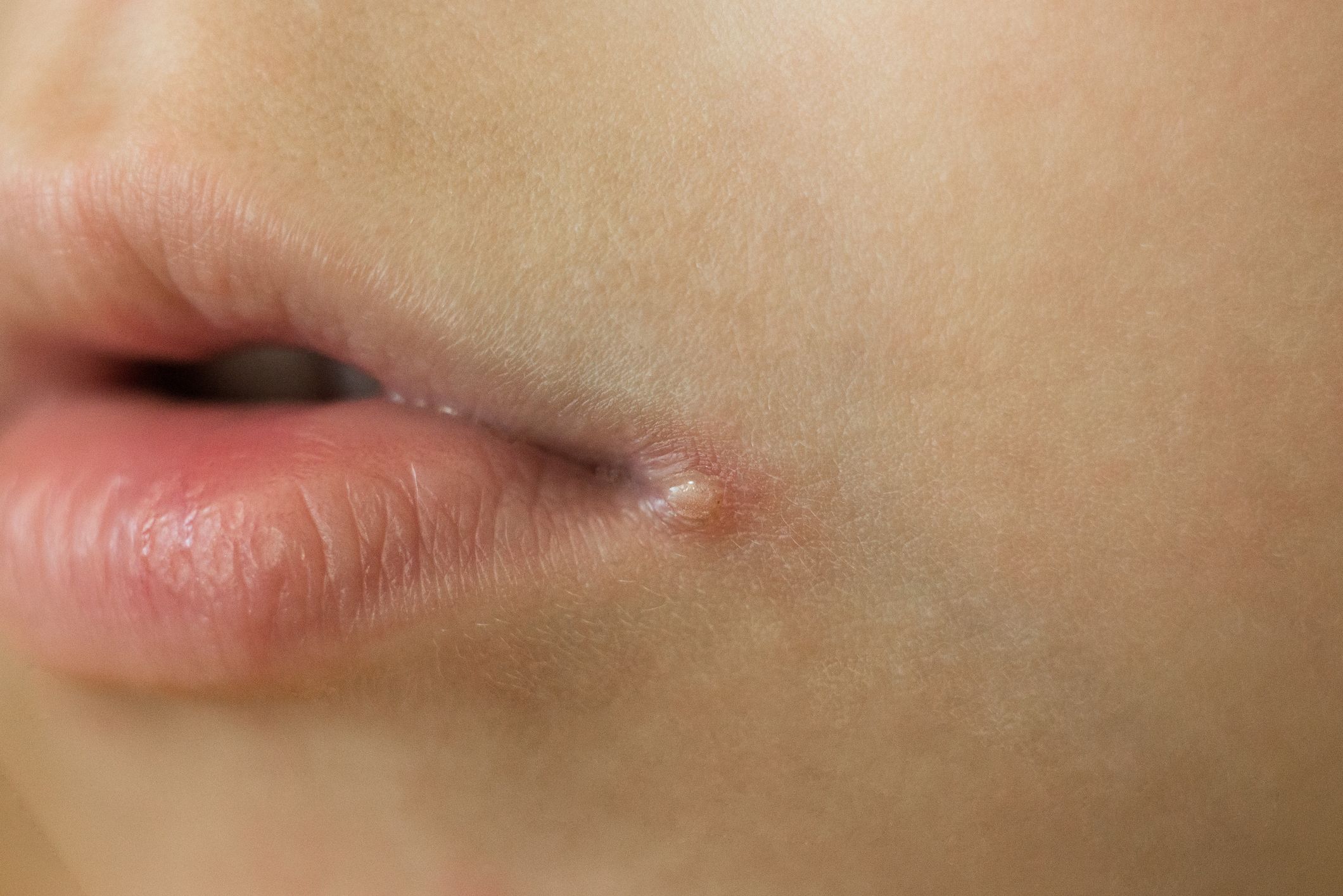 Lip clear bump on Causes of