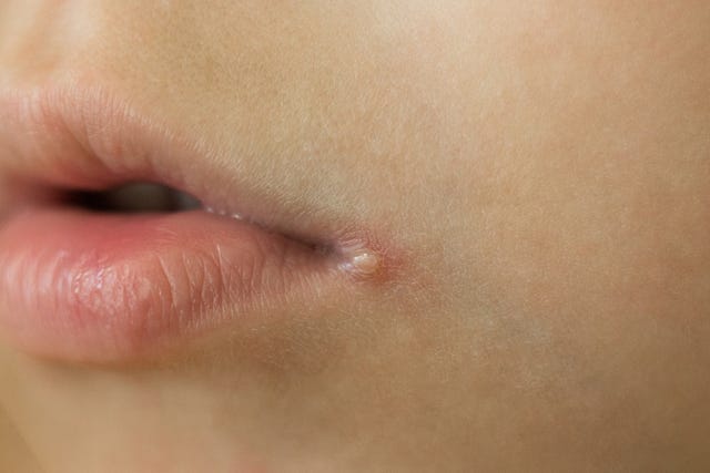 Angular Cheilitis Is Not A Cold Sore On The Corner Of Your Mouth