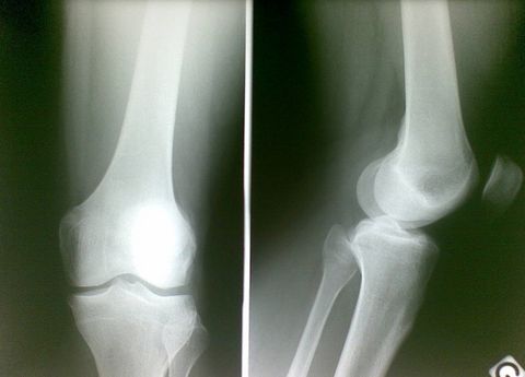 Bone, Joint, White, X-ray, Medical radiography, Radiography, Black, Knee, Medical imaging, Radiology, 