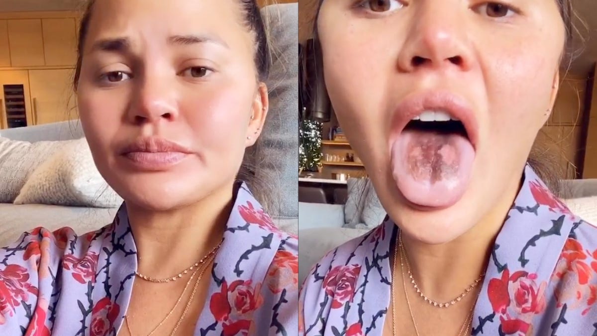 Chrissy Teigen's Tongue Is Peeling From Eating Too Much Sour Candy